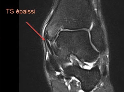 spring ligament