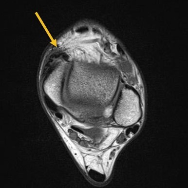 spring ligament