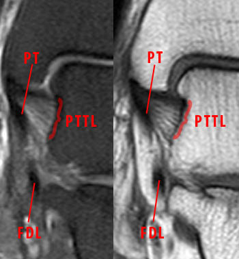 ligament deltoide