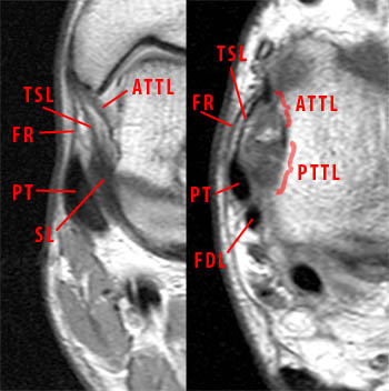 ligament deltoide